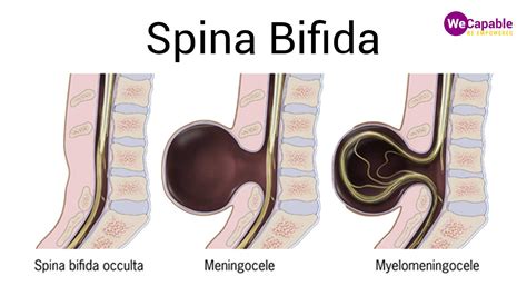 bofuda|Spina bifida